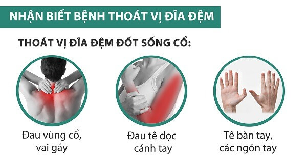 trieu-chung-thoat-vi-dia-dem-cot-song